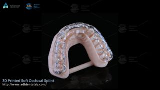 Stecca personalizzata stampata in 3D per il comfort del bruxismo