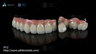 Corone dentali PFZ Resistenza naturale e adattamento preciso