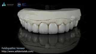 Faccette in ceramica feldspatica ad alta traslucenza per sorrisi