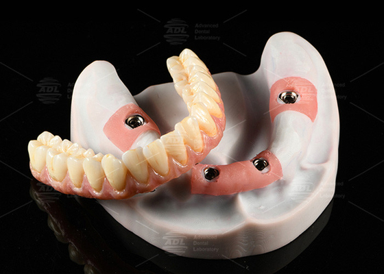 comprare Croce di porcellana rosa composita A1 all'ombra All On 4 Vitruccio ibrido in titanio fabbricazione online