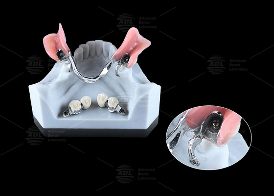 comprare 0.1mm Tolleranza CEKA REVAX Attachment Titanio 3mm Liberamento verticale fabbricazione online
