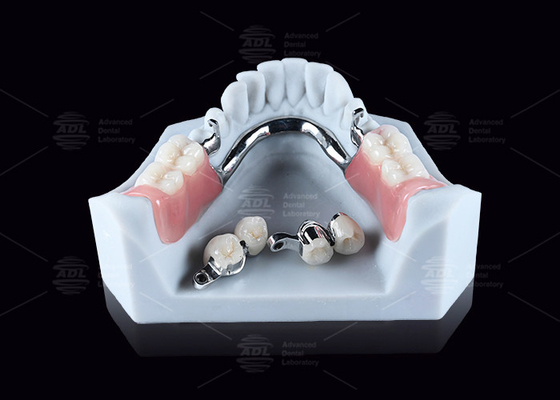 comprare CEKA M2 Precision Attachment Titanium con spazi orizzontali / verticali di 3 mm fabbricazione online
