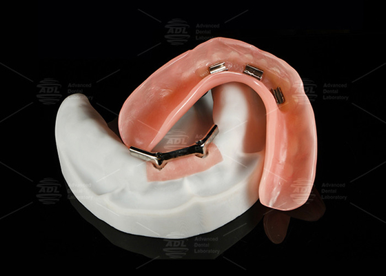comprare Legatura di titanio Snap On Dolder Implant Bar Overdenture lucidato per un sorriso naturale fabbricazione online