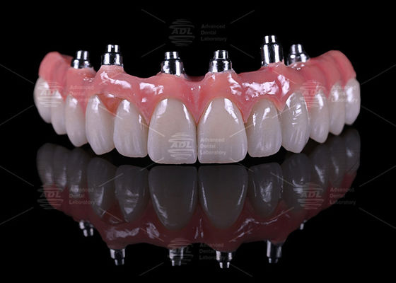comprare Cina Dental Lab Titanio vite mantenuta Malong Design A1 Ombra Full Arch Hybrid Bridge fabbricazione online