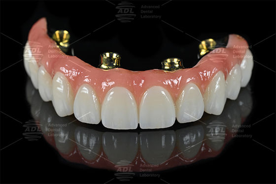 comprare All On X Implant Retenuto Bar Con Velo Retenuto Zirconia Ponte Progettato Per Fornire Superiore Ritenzione E Stabilità Chinese Dental Lab fabbricazione online