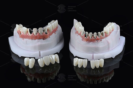 comprare China Dental Lab Titanio Full Arch Hybrid Bridge con caricamento immediato A1 Shade Malong Design Screw Retained Cad/Cam fabbricazione online