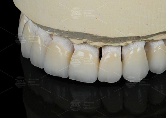 Colore naturale dei denti Veneer ceramico feldspatico per denti anteriori e posteriori