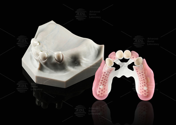 Biocompatibilità Telescopio dentale Bianco Zirconia interna Telescopio esterno Dental