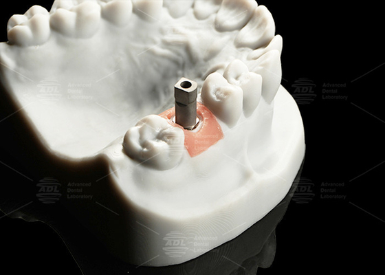 Impianto digitale in titanio di precisione Scansione del corpo superficie sabbiata per CAD/Cam