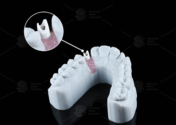 Abutment in zirconia bianco personalizzato, aspetto naturale, estetica e funzionalità ottimale