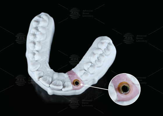 Cimento a vite di titanio ad abitazione interna ad esatto formato mantenuto