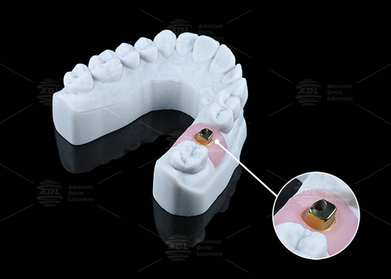 Impianti e soluzioni dentali a base di titanio resistenti alla corrosione personalizzati