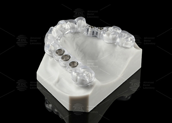 Soluzione per impianti dentali trasparenti su misura Stent chirurgico Disegno ergonomico