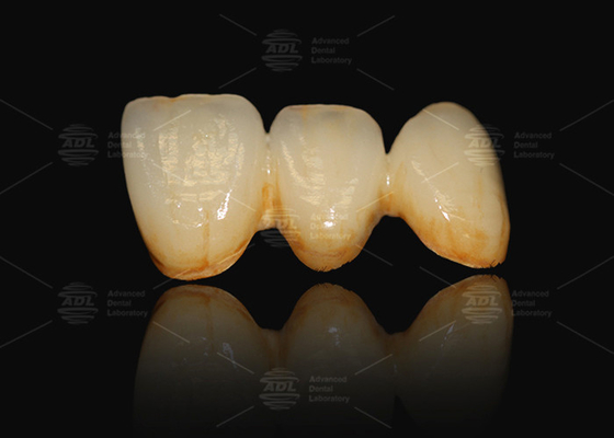 A3 A3.5 Porcellana fusa al metallo e corona dentale in ceramica PFM Cad Cam