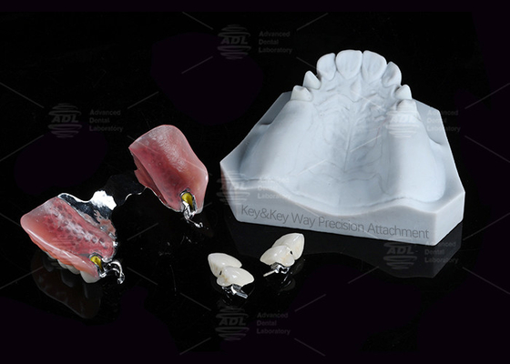 Protesi dentali Via chiave Attachment Precisione Attachment Forza di ritenzione regolabile