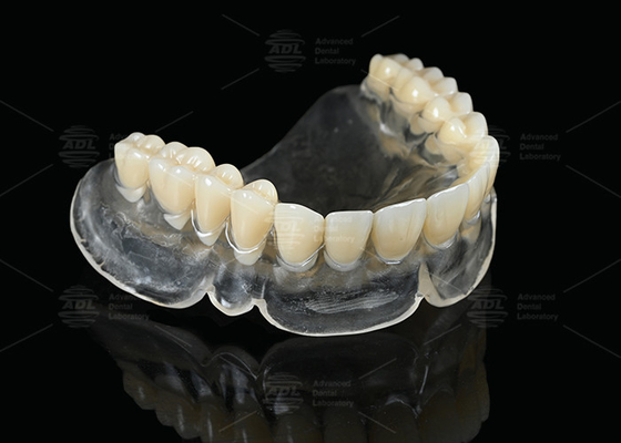 Protesi termoplastiche a cura del calore Vertex Per chi usa protesi complete chiare