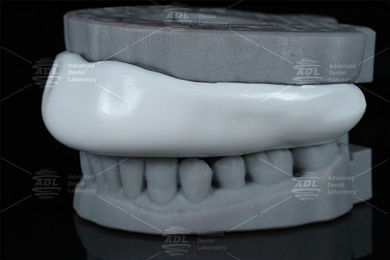 Confortevole Splint Occlusal Sport Guard Bite Splint Design Facile Da Pulire Comodo Dispositivo Protettivo Per Grindare I Denti