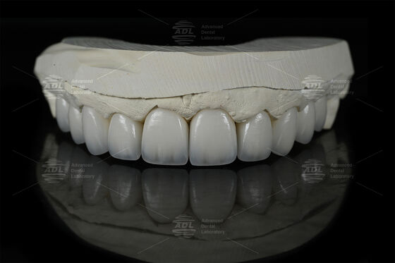 0.3mm-0.7mm Feldipatico EMAX Ceramiche Natural Estetico Emax Dental Veneers